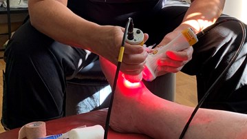 Laserbehandling av sår på foten.