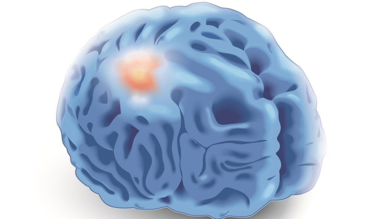 Illustration av hjärntumör.