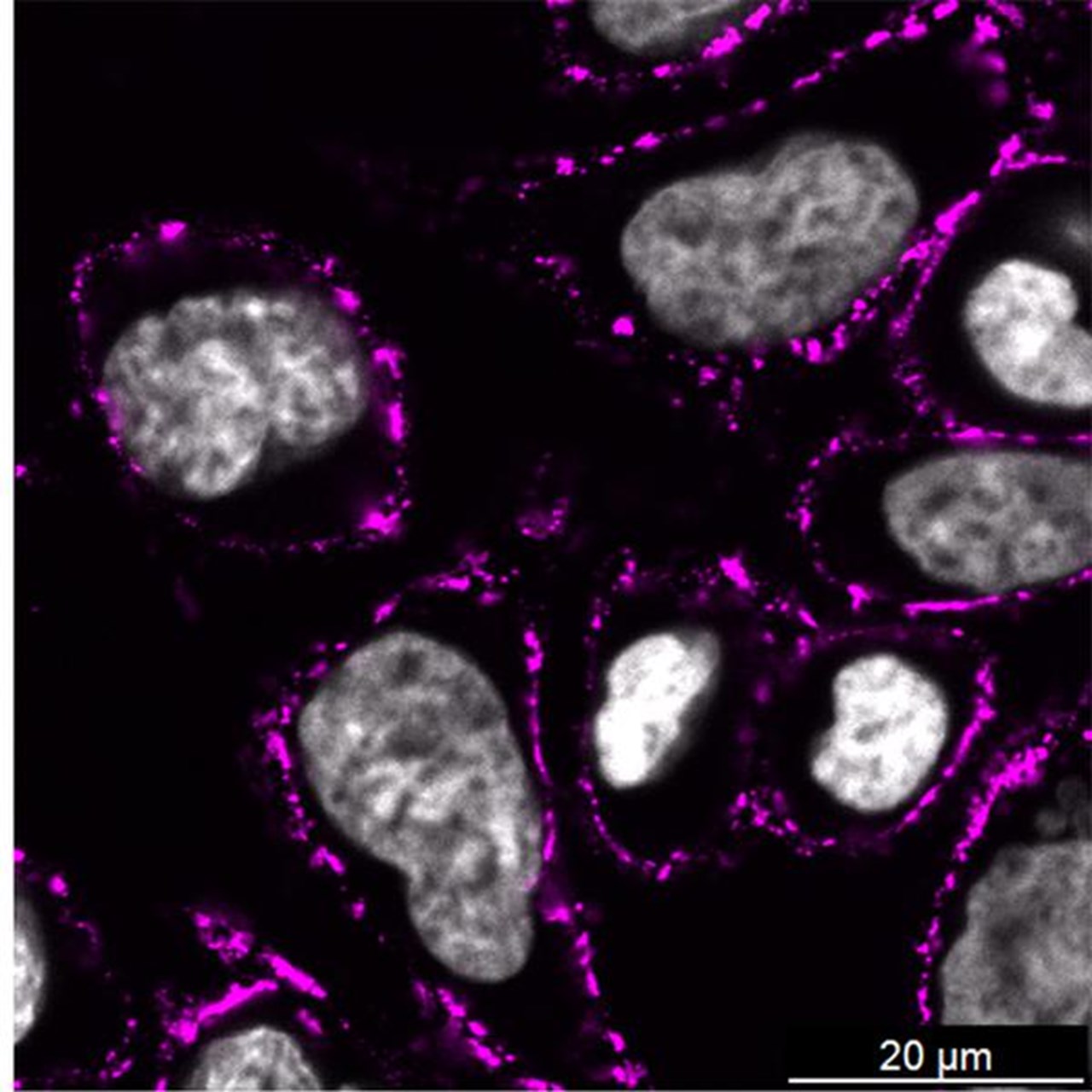 Bilden visar hur NheA-O (markerad i magenta) binder till cellmembranet hos kolorektala cancerceller.