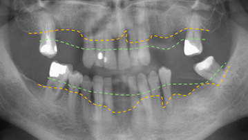 En röntgenbild på en person med parodontit, tandlossningssjukdom.