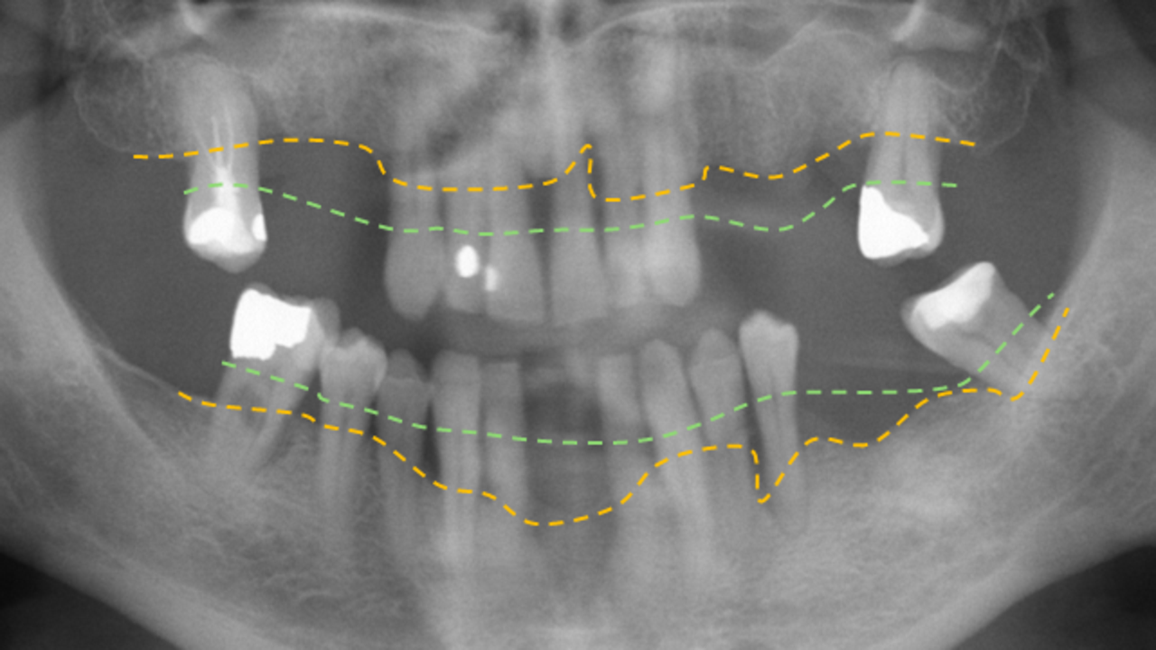 En r&ouml;ntgenbild p&aring; en person med parodontit, tandlossningssjukdom.