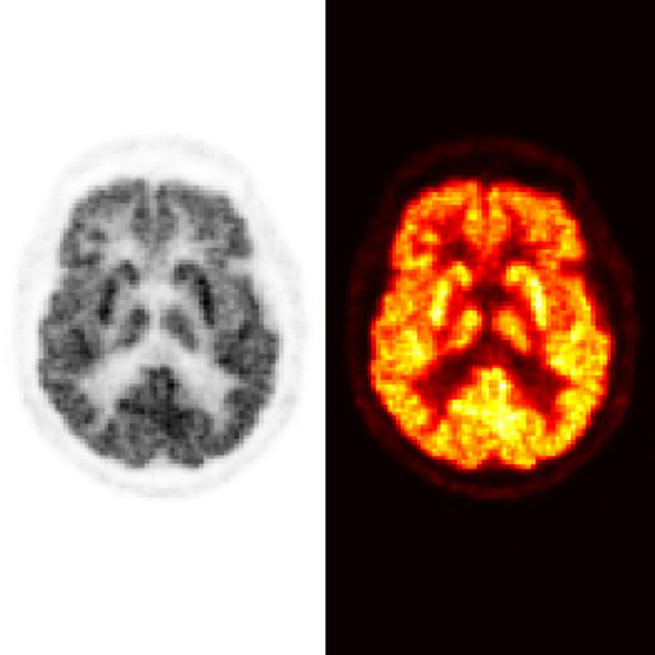 Bilder från en PET-undersökning