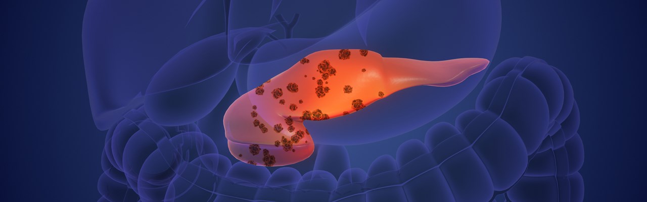 Pancreascancer