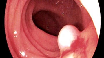 Bild inifrån tjocktarm med koloskopi och synlig polyp från tarmväggen