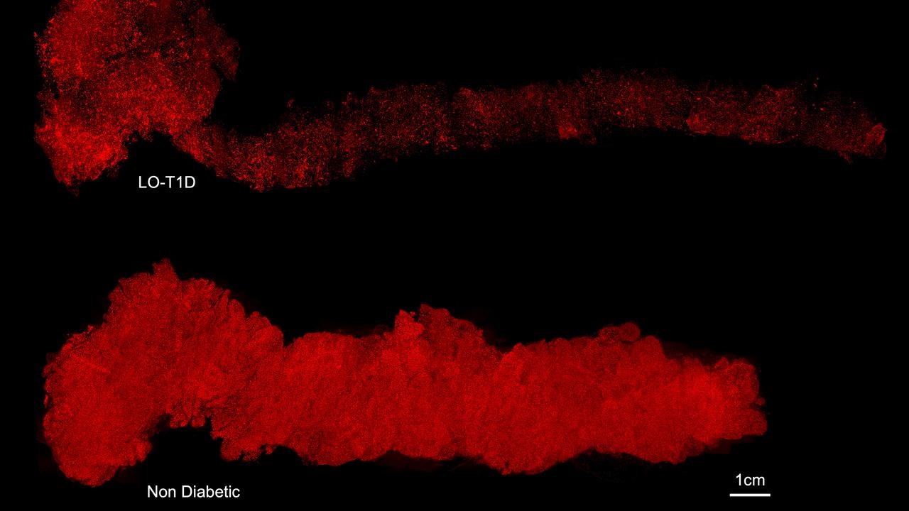 Tredimensionella bilder av hela m&auml;nskliga bukspottk&ouml;rtlar i vilka de Langerhanska cell&ouml;arna &auml;r f&auml;rgade f&ouml;r insulin (r&ouml;tt). Trots den markanta skillnaden mellan bukspottk&ouml;rteln fr&aring;n den icke-diabetiska donatorn och typ 1 diabetes donatorn, hade den senare fortfarande kvar hundratusentals insulinproducerande celler.