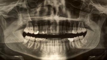 Röntgenbild på käke och tänder.