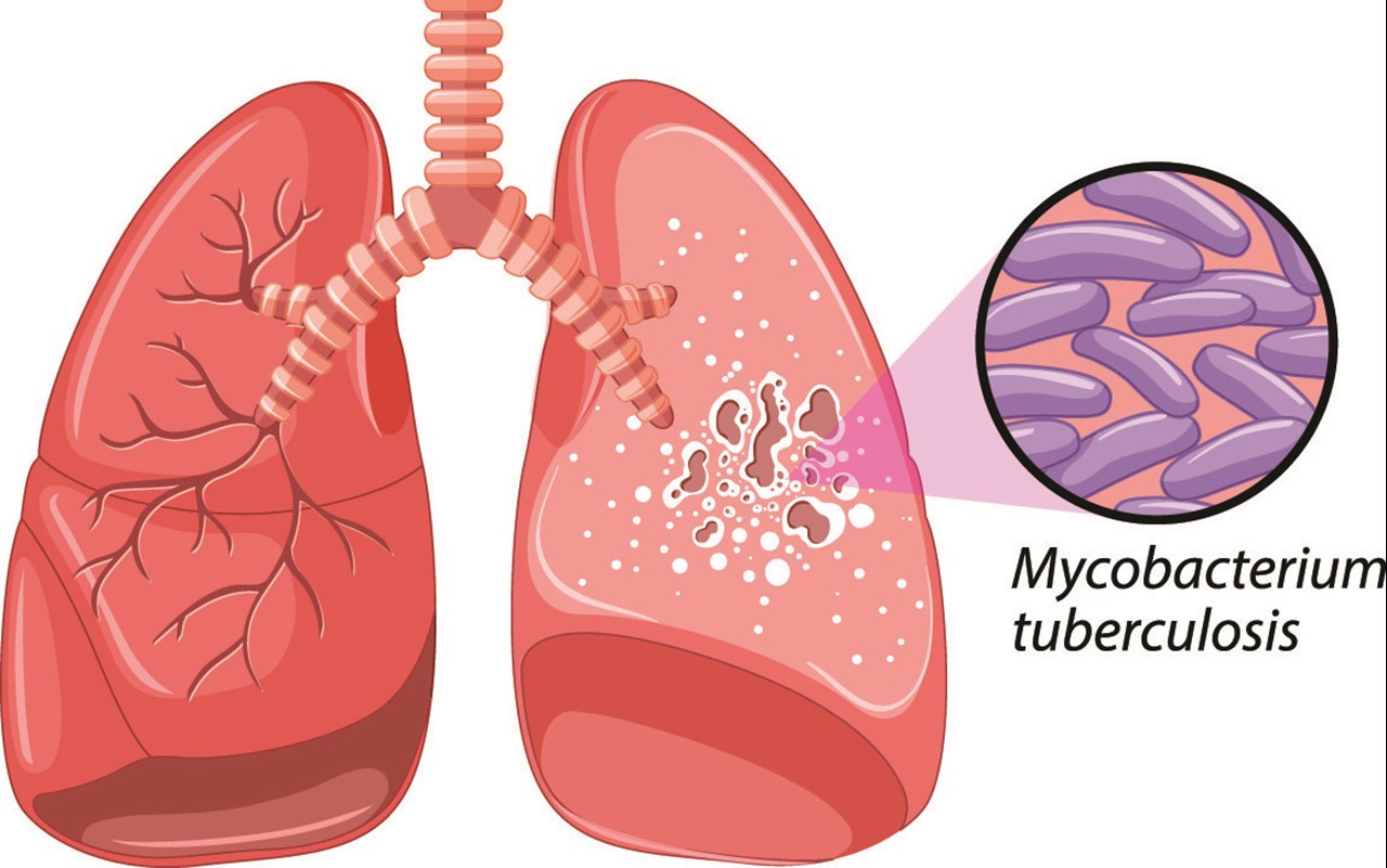 Illustration över lungor angripna med tuberkulos.