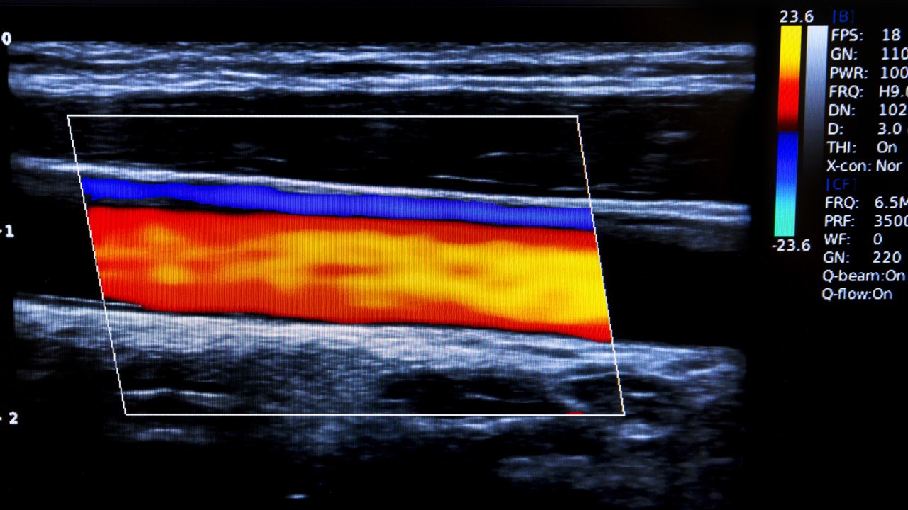 Ultraljudsbild på en åderförkalkad halsartär.