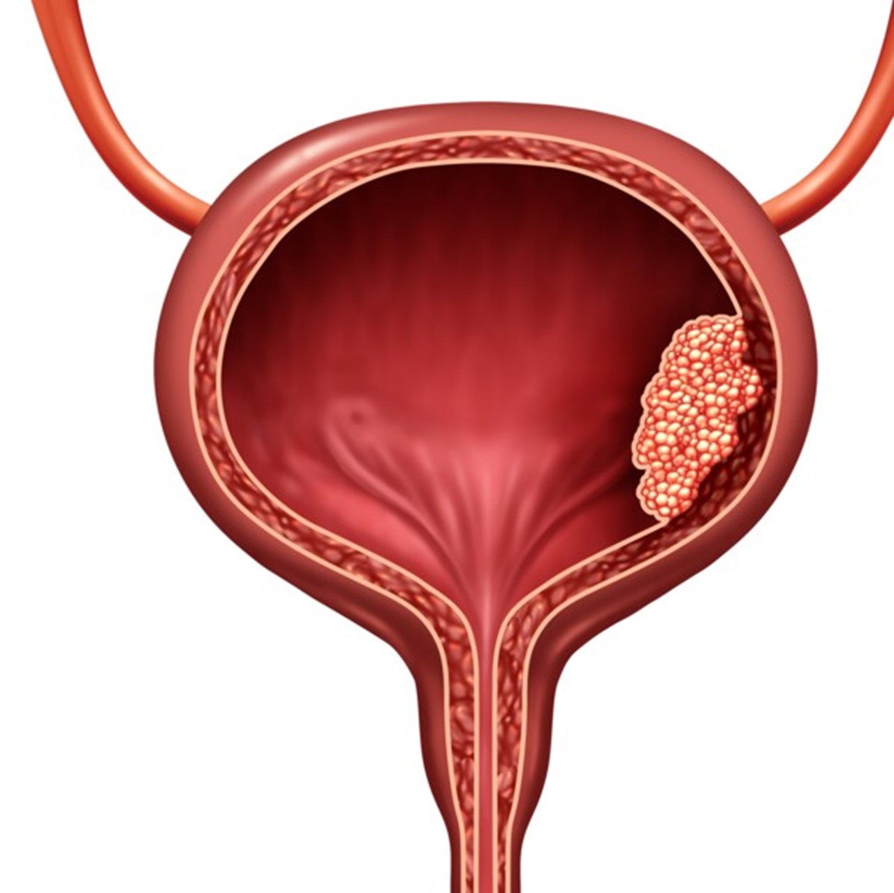 Schematisk illustration av tumör i urinblåsan.