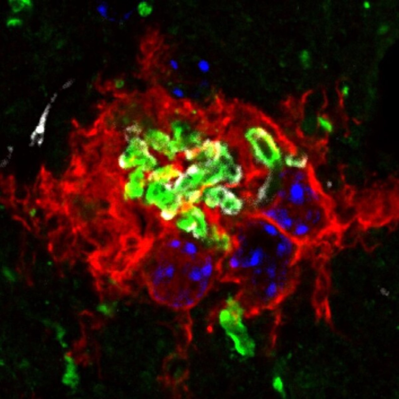 Bilden visar klumpar av SOD1-protein (grönt) som bildas i ryggmärgen vid en typ av ALS.   Antikroppar som bundit till SOD1-klumparna i de behandlade mössen ser man som små vita fläckar runt det gröna.  I rött syns hjärnans immunceller som omringat det felaktiga proteinet för att försöka bryta ned det.