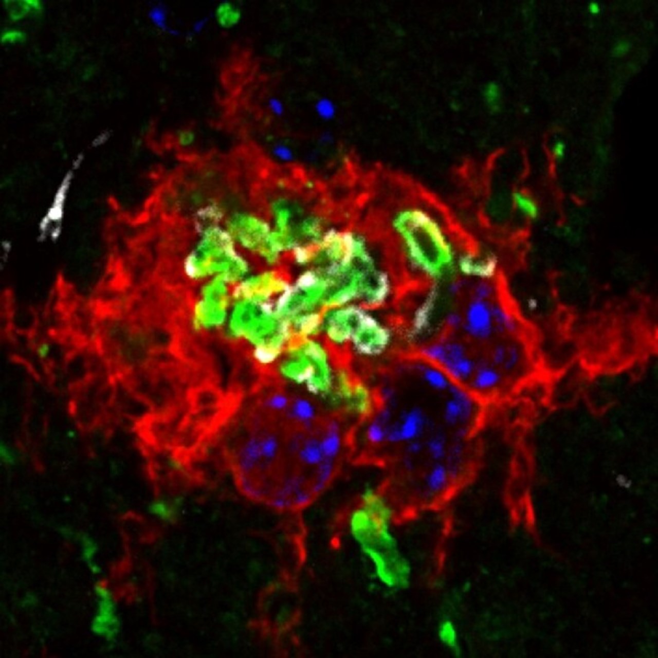Bilden visar klumpar av SOD1-protein (grönt) som bildas i ryggmärgen vid en typ av ALS.   Antikroppar som bundit till SOD1-klumparna i de behandlade mössen ser man som små vita fläckar runt det gröna.  I rött syns hjärnans immunceller som omringat det felaktiga proteinet för att försöka bryta ned det.