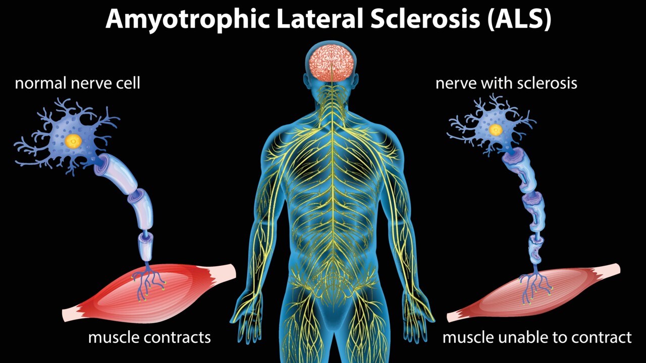 Schematisk illustration av hur ALS gör att nerver förlorar kontakten med musklerna