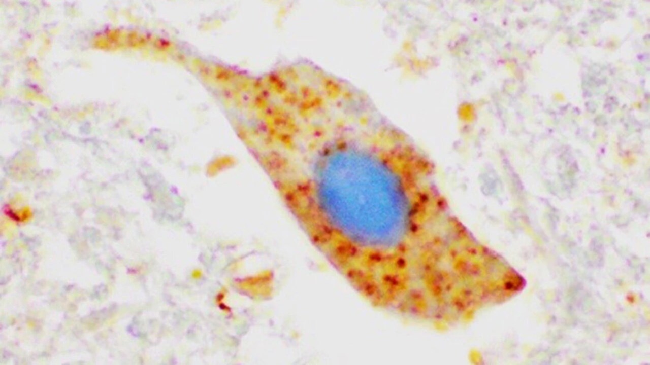 Microscopic image of a motor neuron with aggreated SOD1.