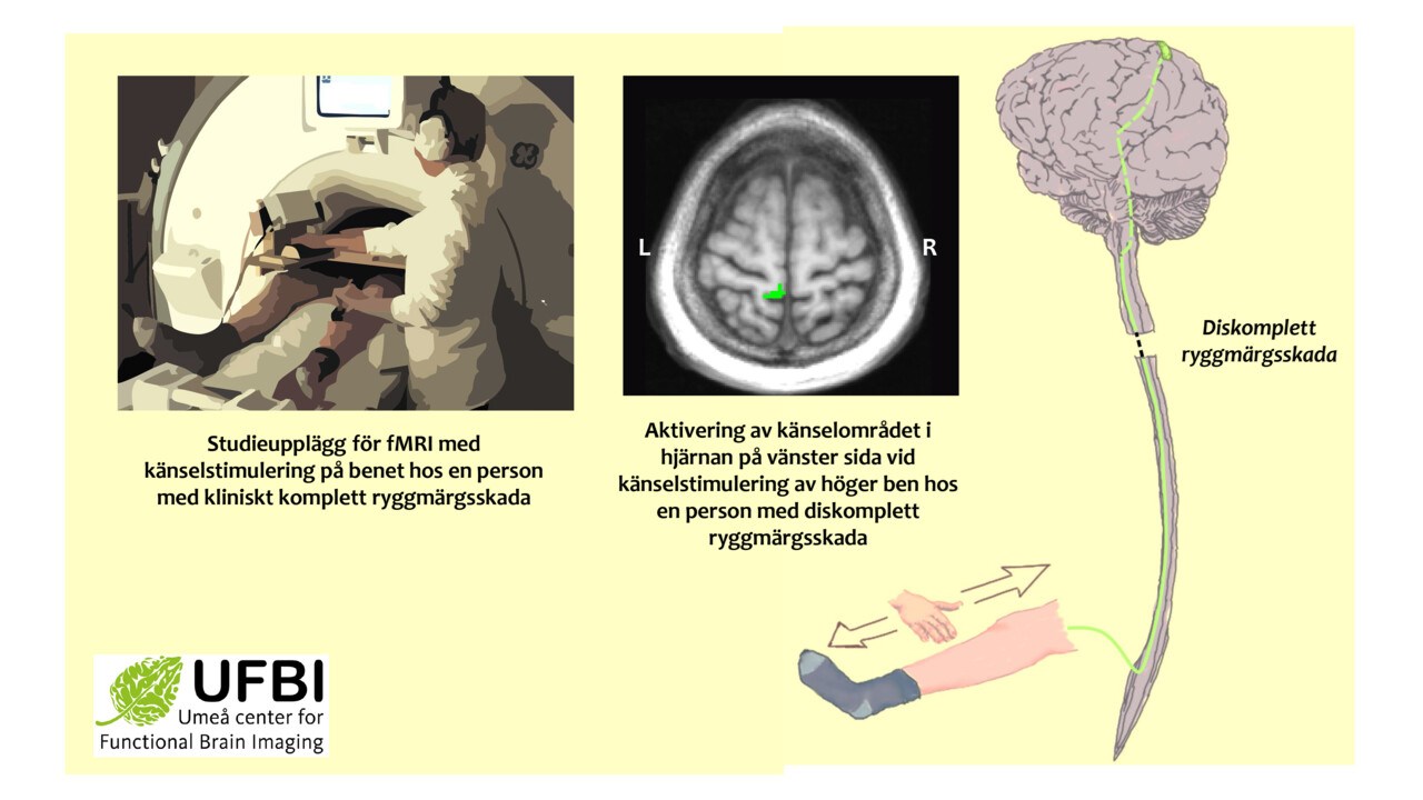 Schematisk bild av funktionell magnetresonanstomografi och område i hjärnan som stimuleras vid beröring hos patient med diskomplett ryggmärgsskada