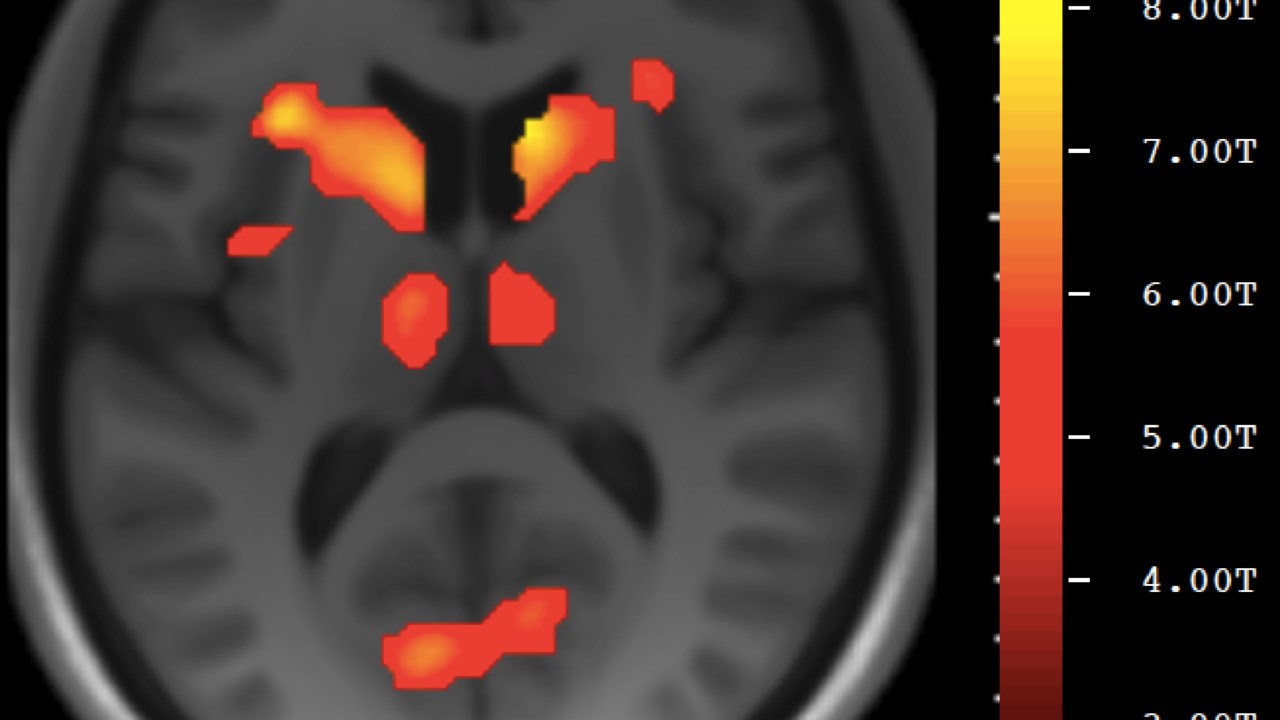 fMRI-bild av hjärnan