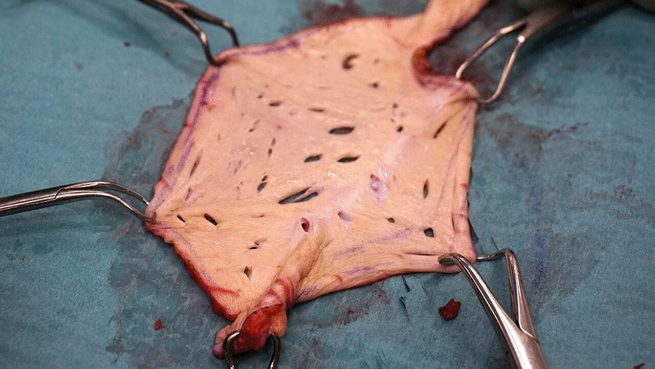 En stor bit hud med operationsklämmor på grön operationsduk