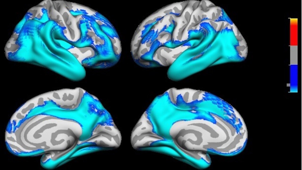 Fyra bilder på områden i hjärnan som är känsliga för krympning