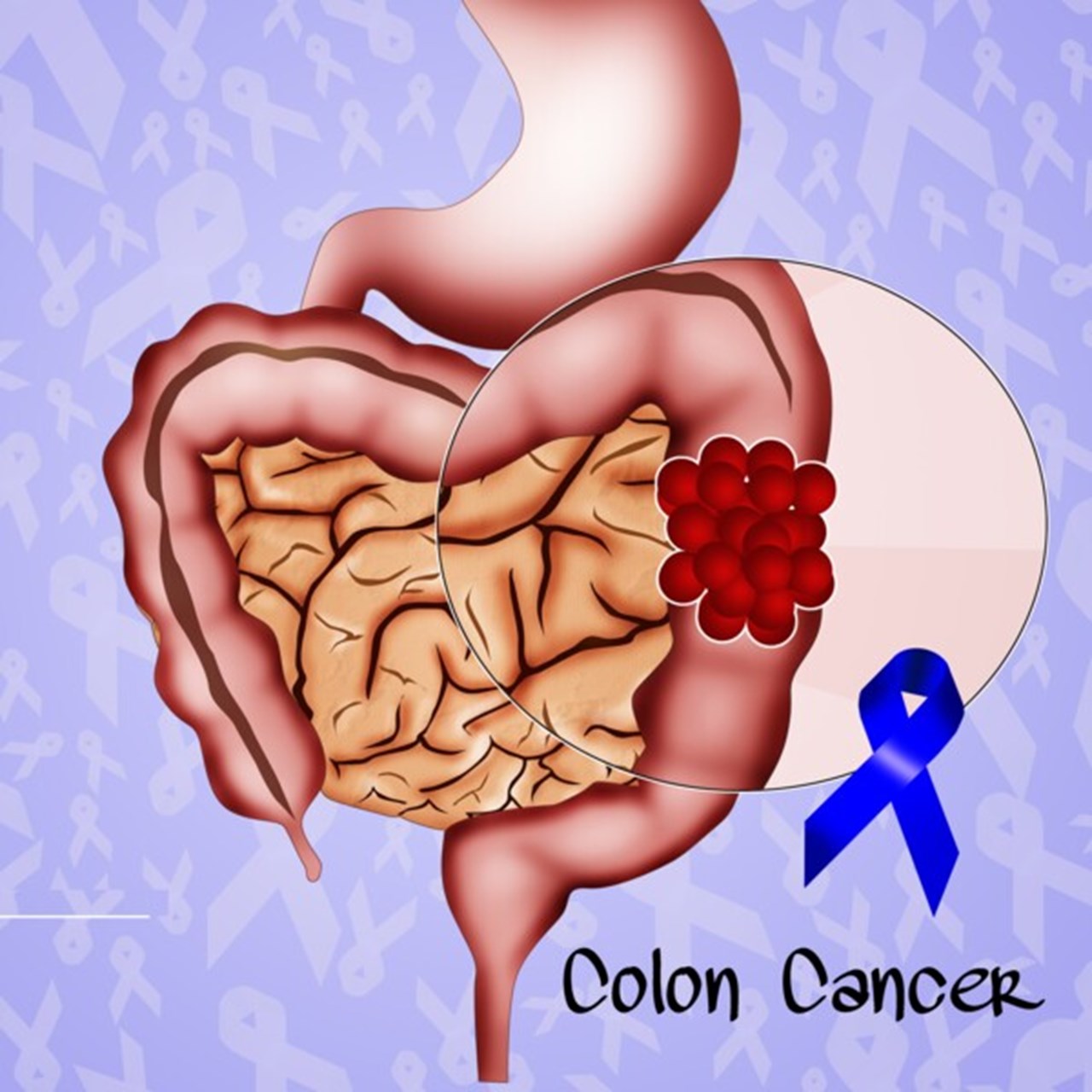Kolorektalcancer, schematisk illustration av cancer i tjocktarmen