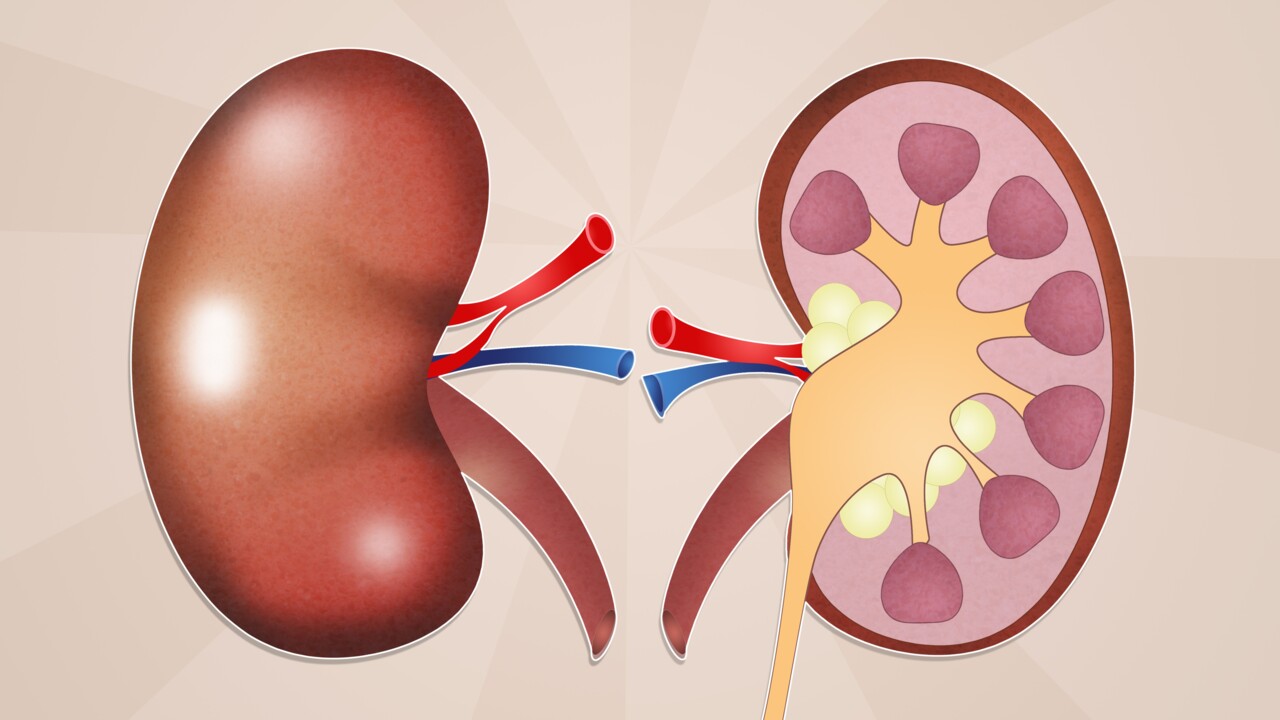 Kidney cancer thesis image