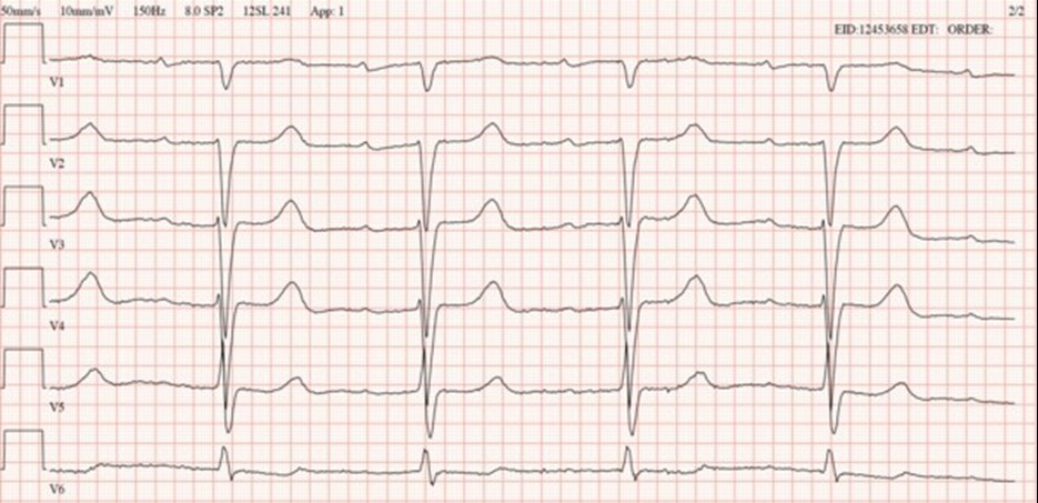 EKG hos patient med wtATTR