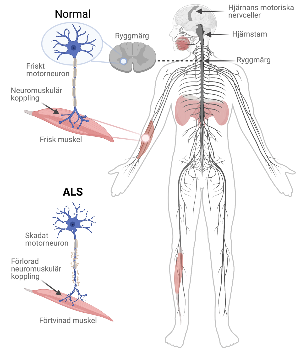 Bild på människans nerver, Skadat motorneuron orsakat av ALS