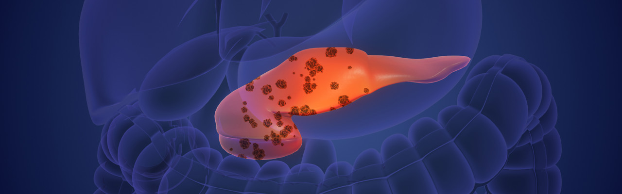 Pancreatic damage can contribute to the growth of cancer cells in the pancreas. Pancreatic cancer is a complex disease, and while the exact causes are not always clear, several factors, including pancreatic damage, can increase the risk of cancer development.Pancreatic cancer is a disease in which malignant (cancer) cells form in the tissues of the pancreas. Smoking and health history can affect the risk of pancreatic cancer. Signs and symptoms of pancreatic cancer include jaundice, pain, and weight loss. Pancreatic cancer is difficult to diagnose early.