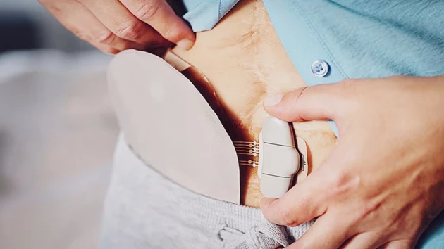 Photo of leakage notification device for people with a stoma