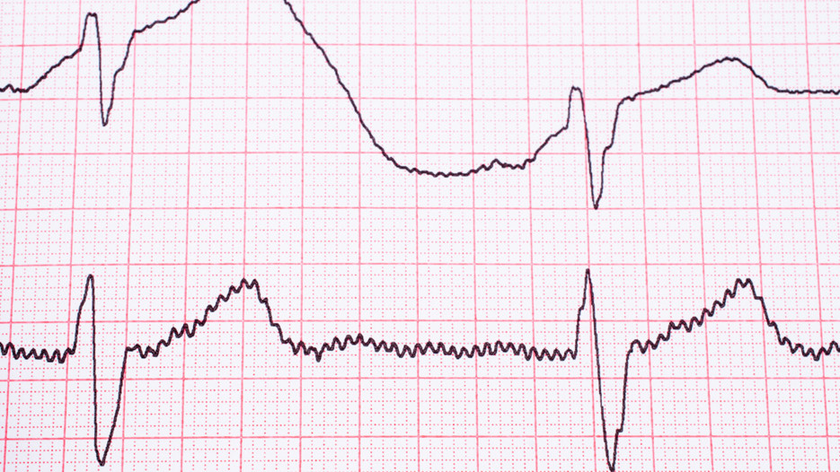 EKG-kurva på papper.